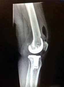 Knee X-Ray